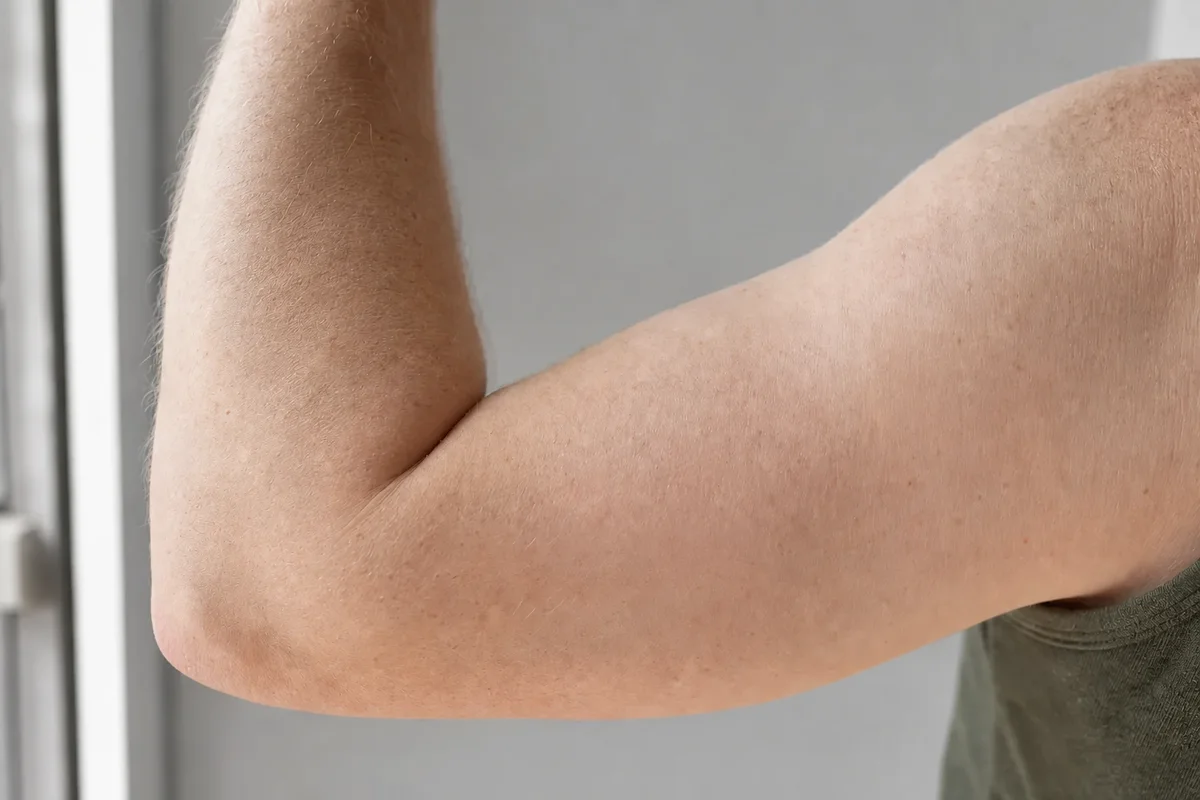 The same upper arm after a completed course of PicoSure laser sessions, with the tattoo removed
