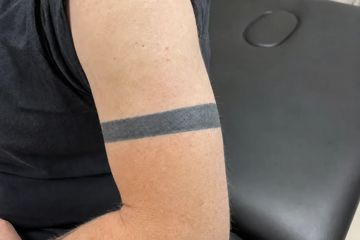 Solid black armband tattoo around an upper arm before laser tattoo removal