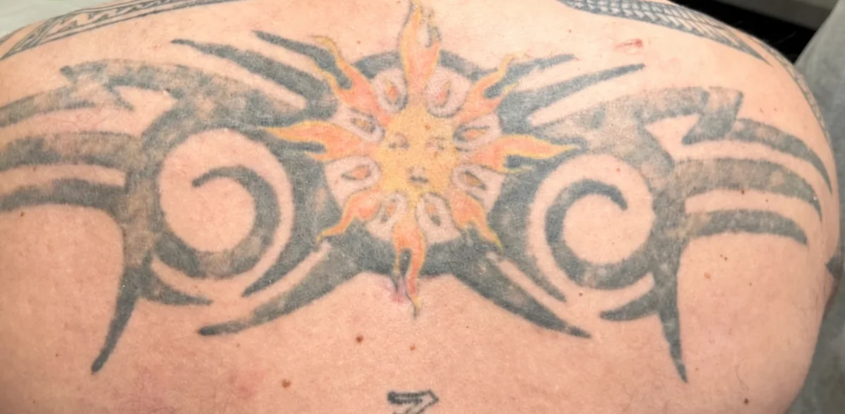 The same upper-back tribal lightened from solid black to a softer mottled grey after laser sessions