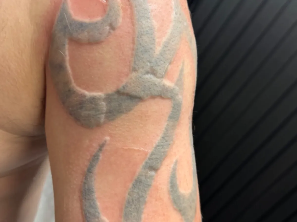 A shoulder tattoo immediately after a laser session, showing white frosting over the ink with surrounding redness and mild swelling