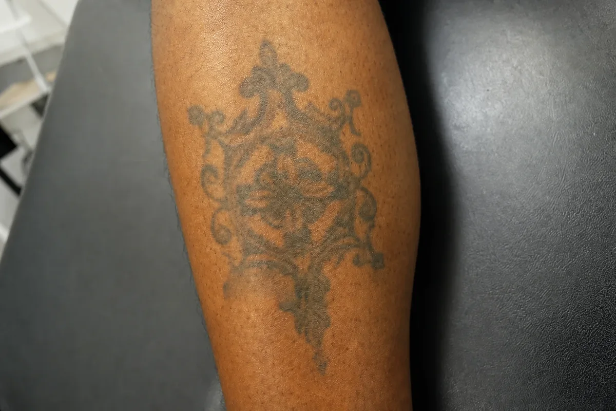 Black ornamental filigree tattoo on a calf before laser tattoo removal at Ink Off Melbourne