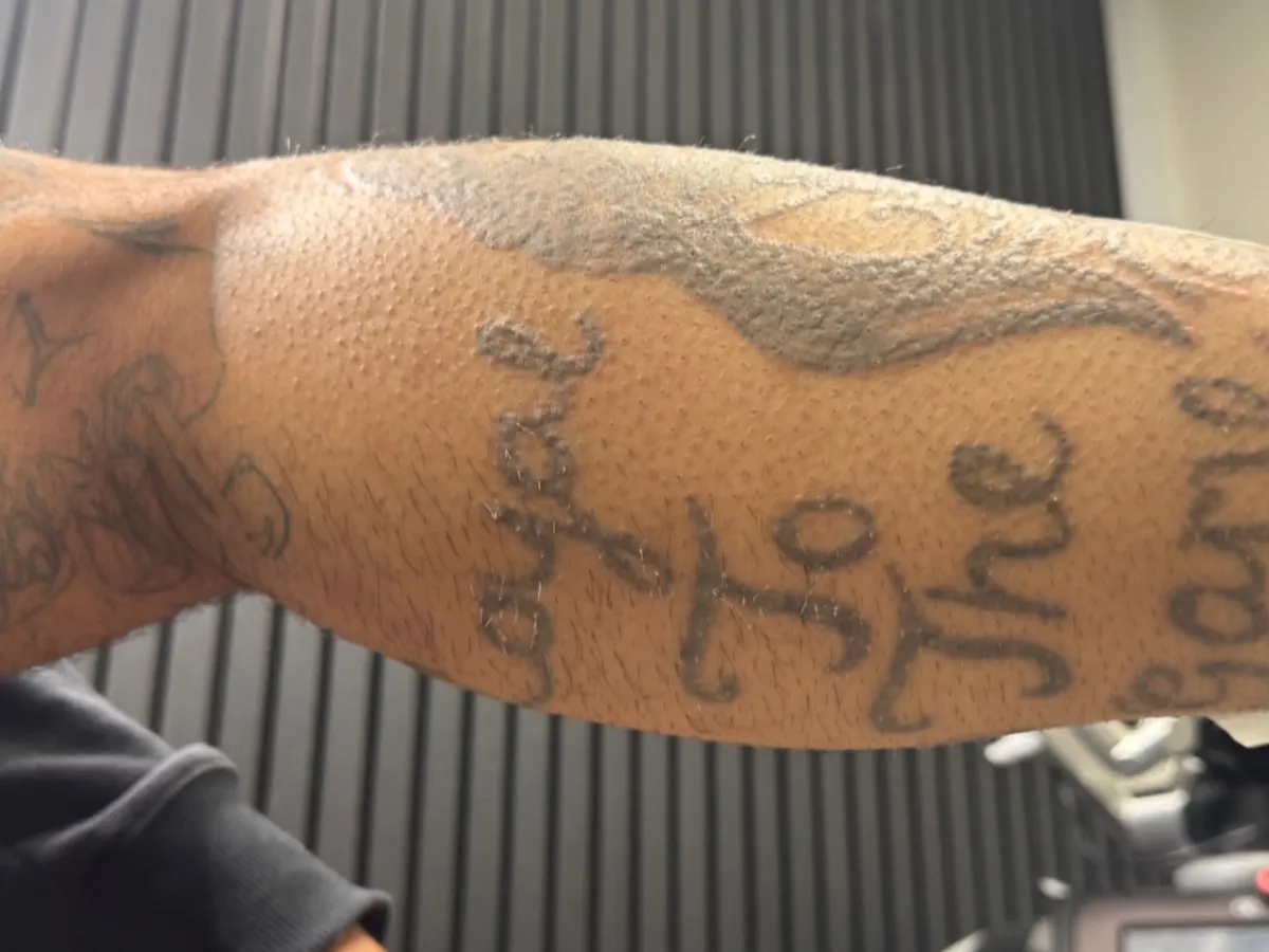 The same heavy black forearm tattoo almost clear of ink after 9 laser sessions, with only a faint shadow remaining