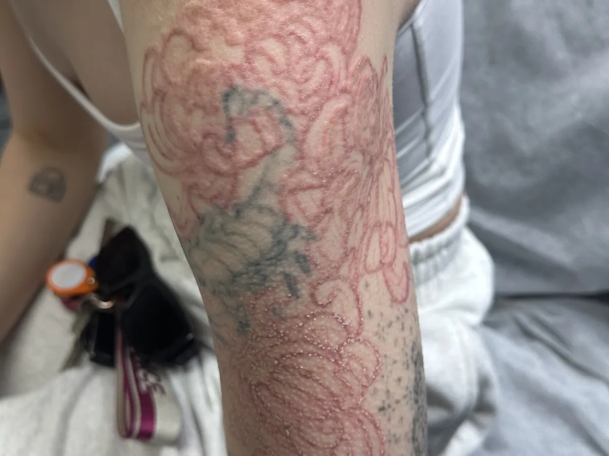 The same colour Japanese sleeve heavily faded to faint outlines after 11 laser sessions
