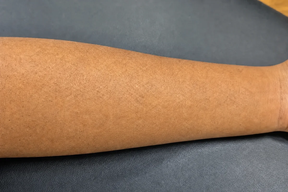 The same forearm after a completed course of PicoSure laser sessions, with the script removed
