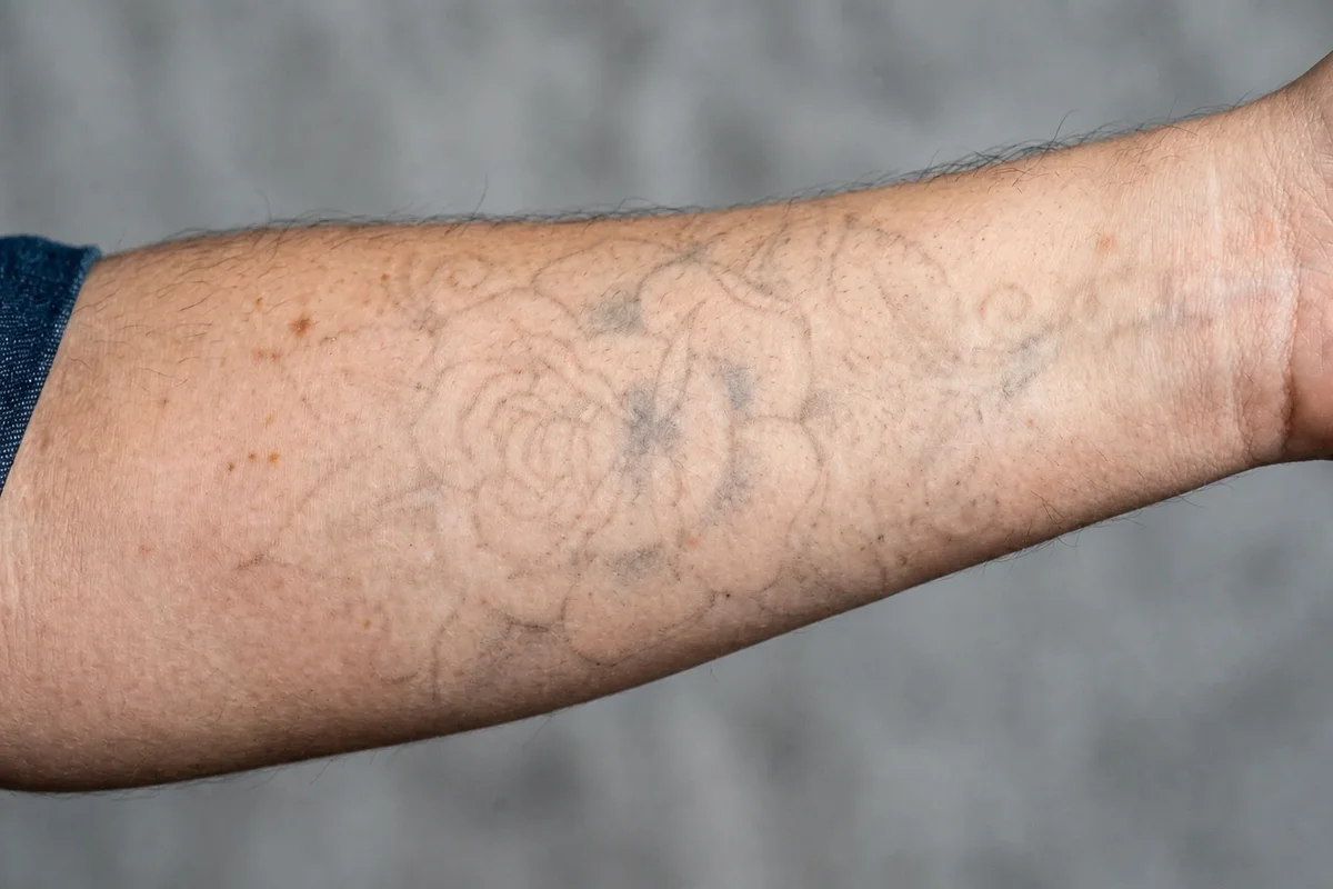 The same forearm rose with the colour gone and only a faint grey outline remaining after laser sessions