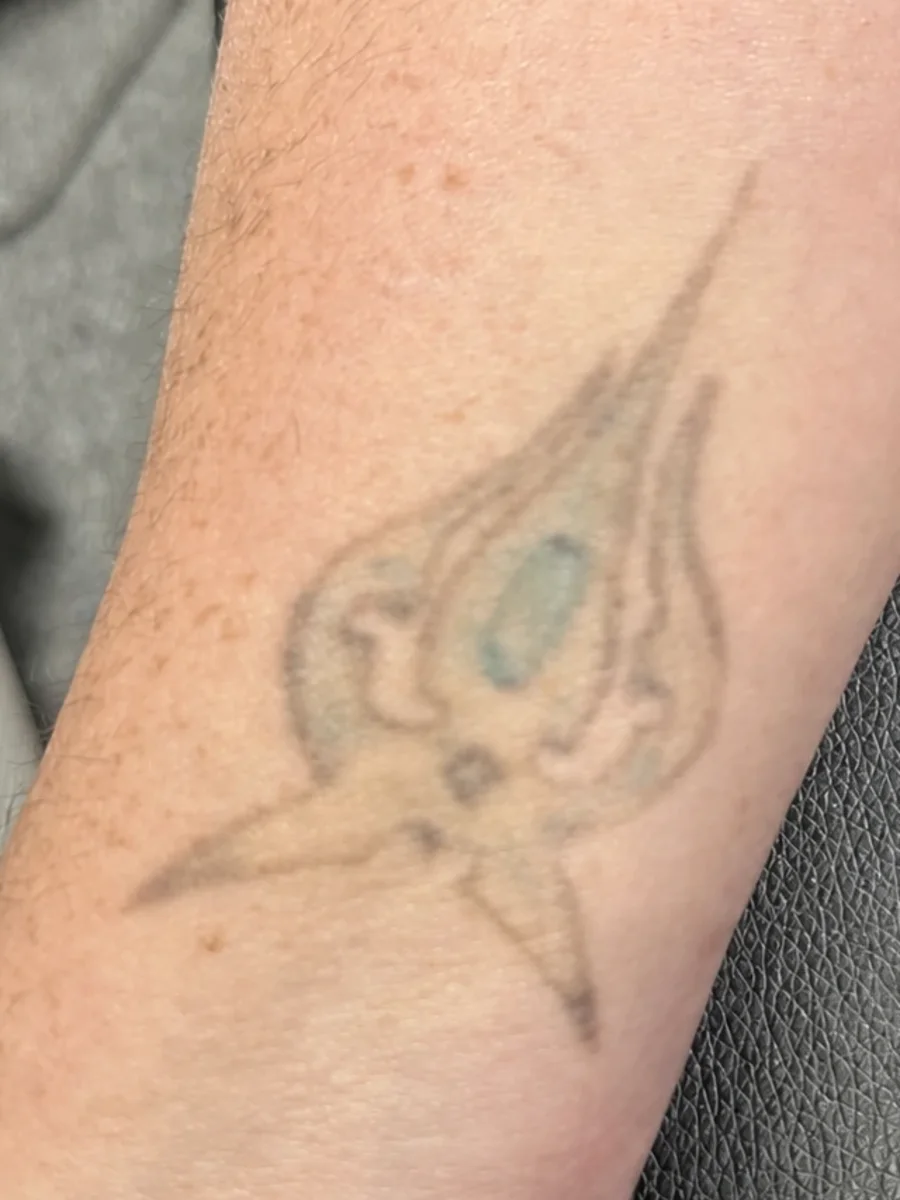The same forearm tribal faded to a soft ghost with the teal much reduced after laser sessions