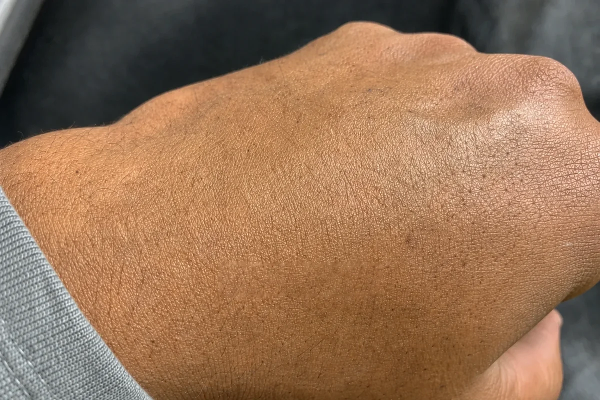 The same hand after a completed course of PicoSure laser sessions, with the tattoo removed