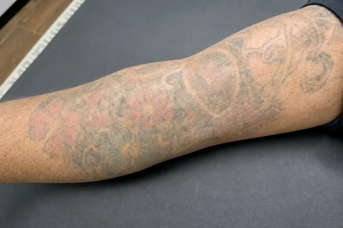 The same colour Japanese sleeve visibly lighter and washed back after laser sessions, with pigment still remaining
